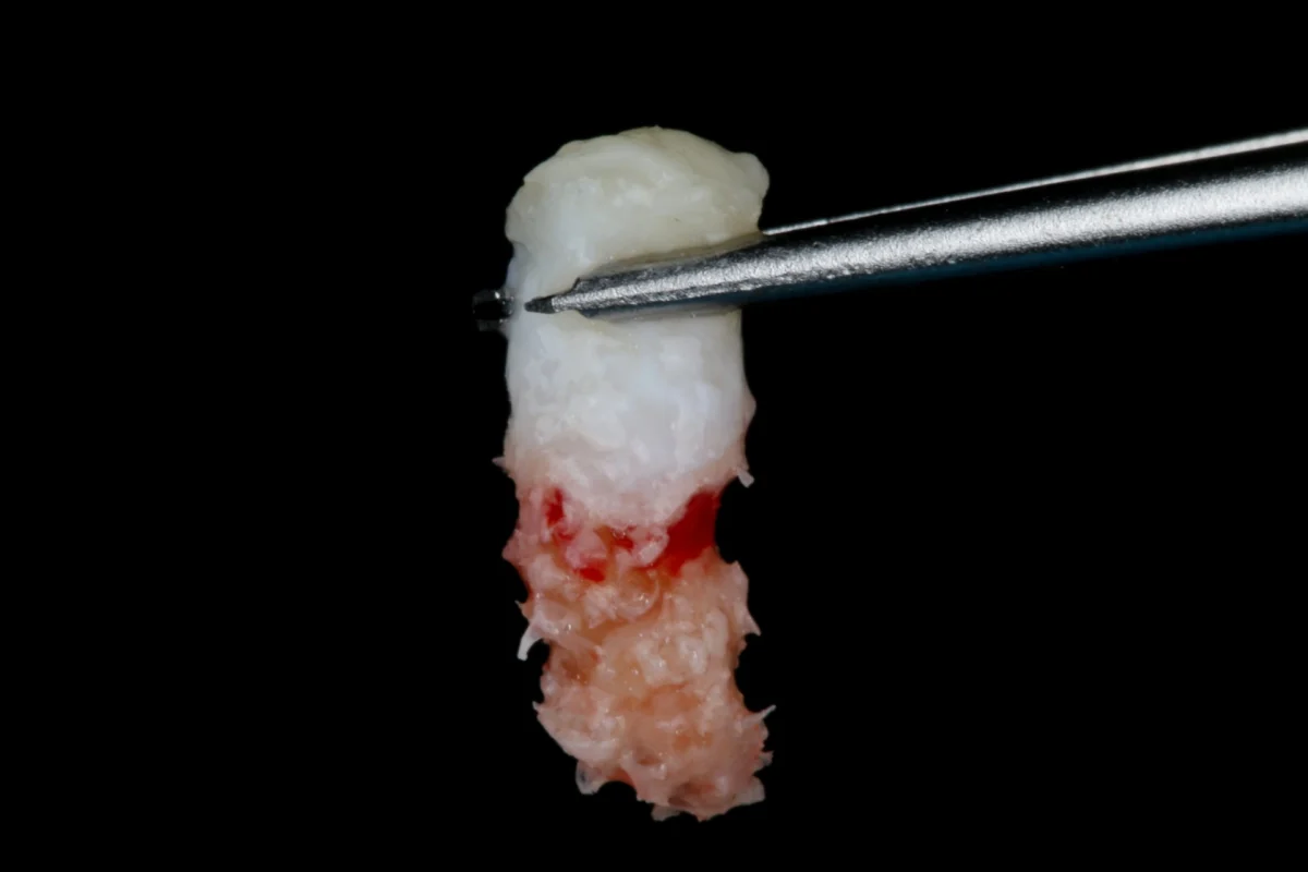 imagen de un injerto óseo enfocado a regeneración ósea