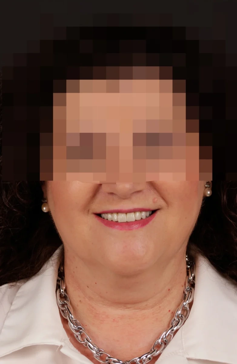 Implantes dentales