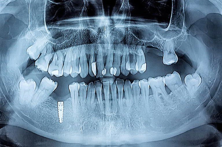 implantes dentales