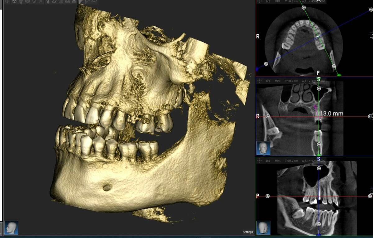 implantes dentales