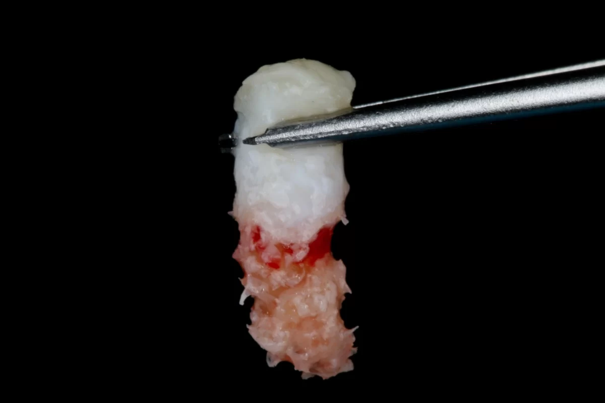 Regeneración ósea acelerada