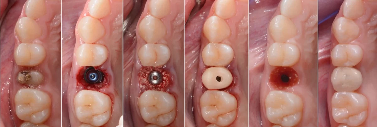 Implantes inmediatos