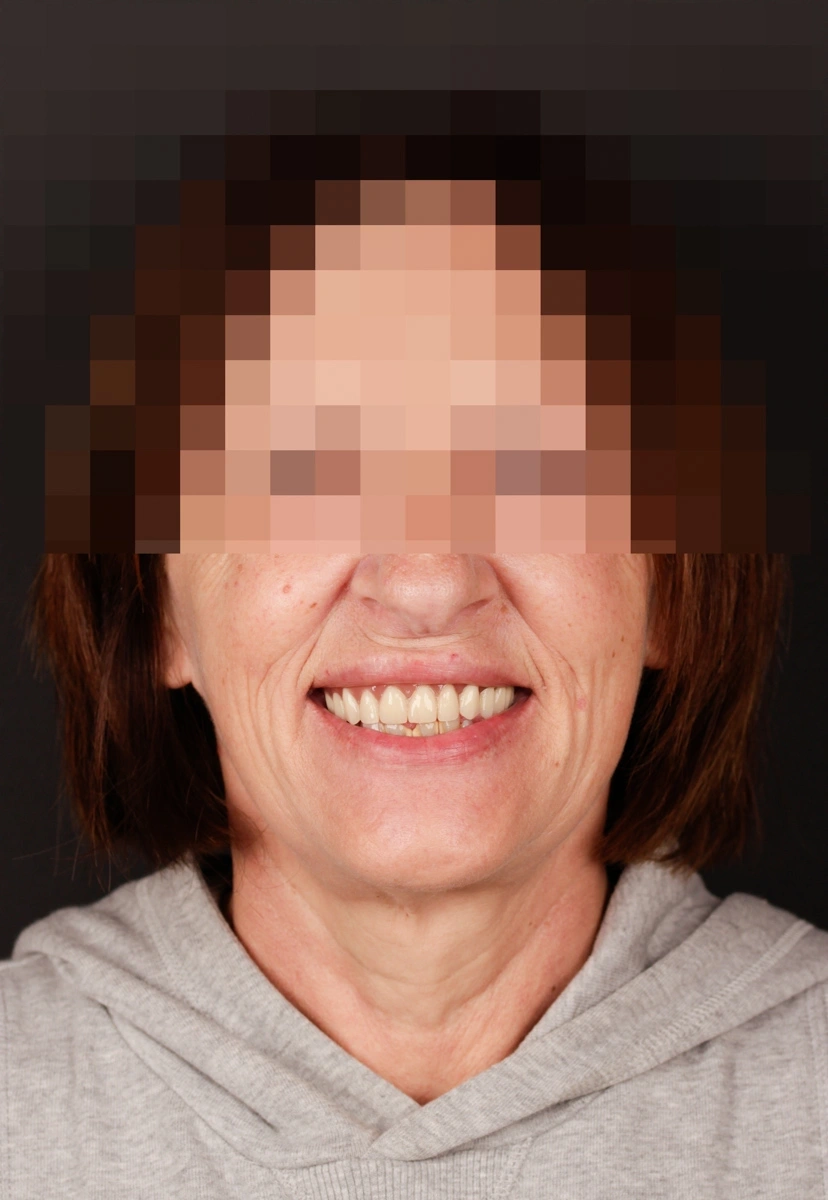 Implantes inmediatos