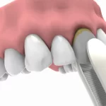 Implantes inmediatos