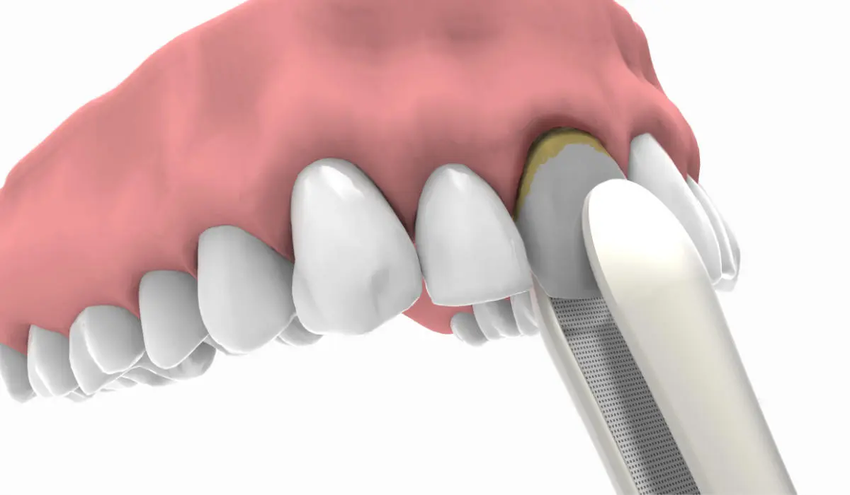Implantes inmediatos
