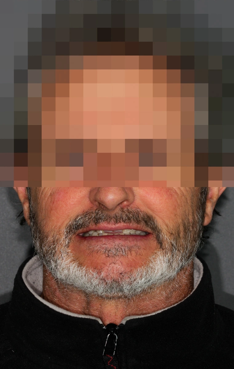 Implantología digital en Zaragoza