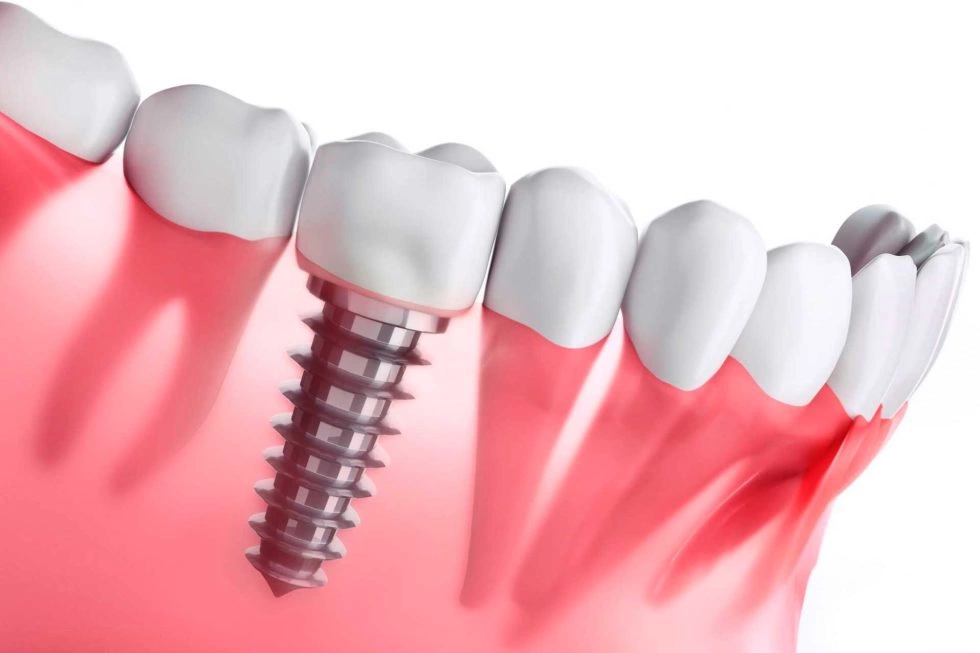 Implantes dentales