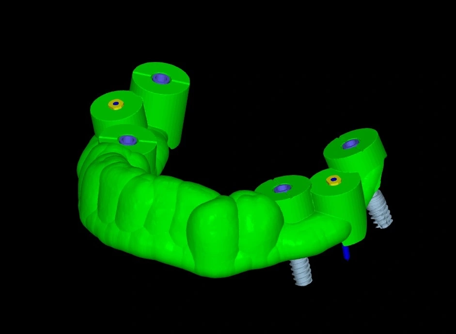 Implantología digital en Zaragoza