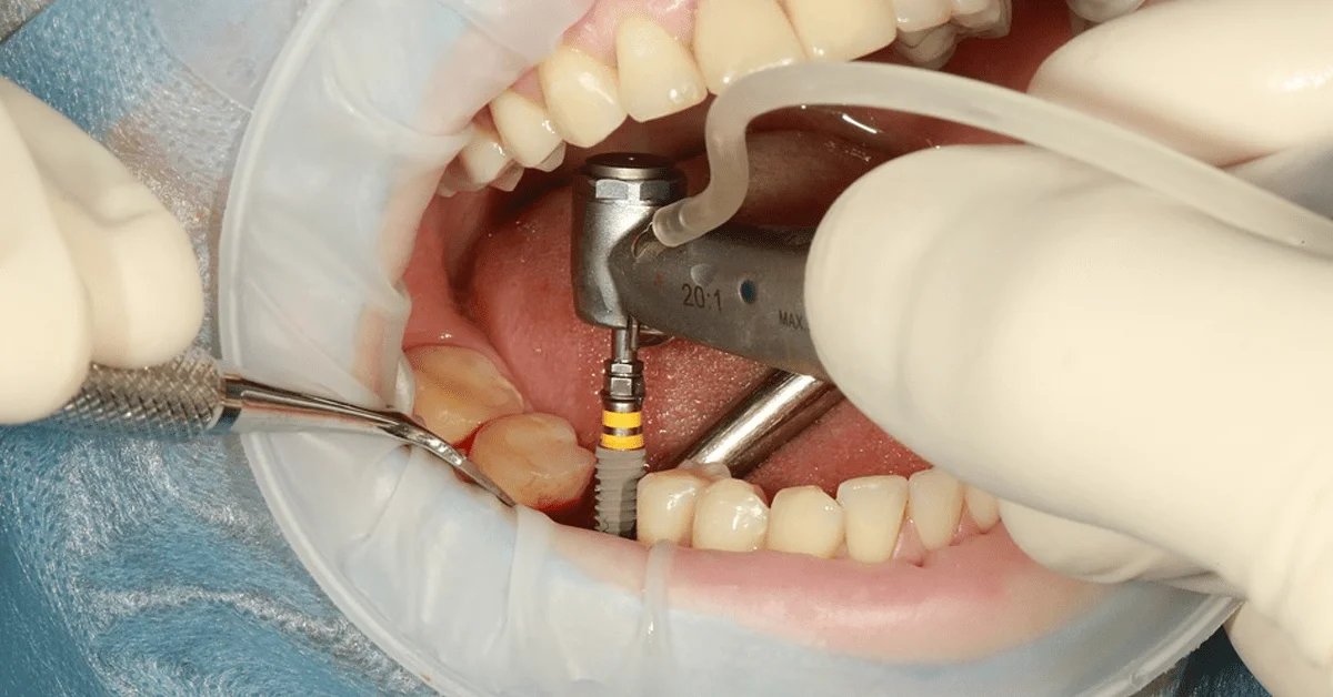 Implantes dentales